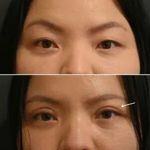 comparison of eyelids after double eyelid surgery