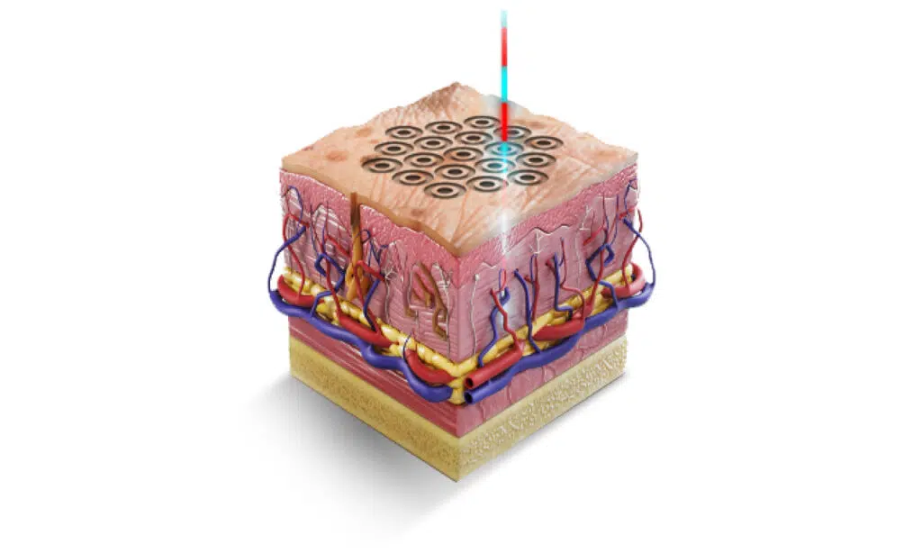 Dermal Coring Graphic