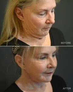 before and after image of a woman who's undergone facelift surgery