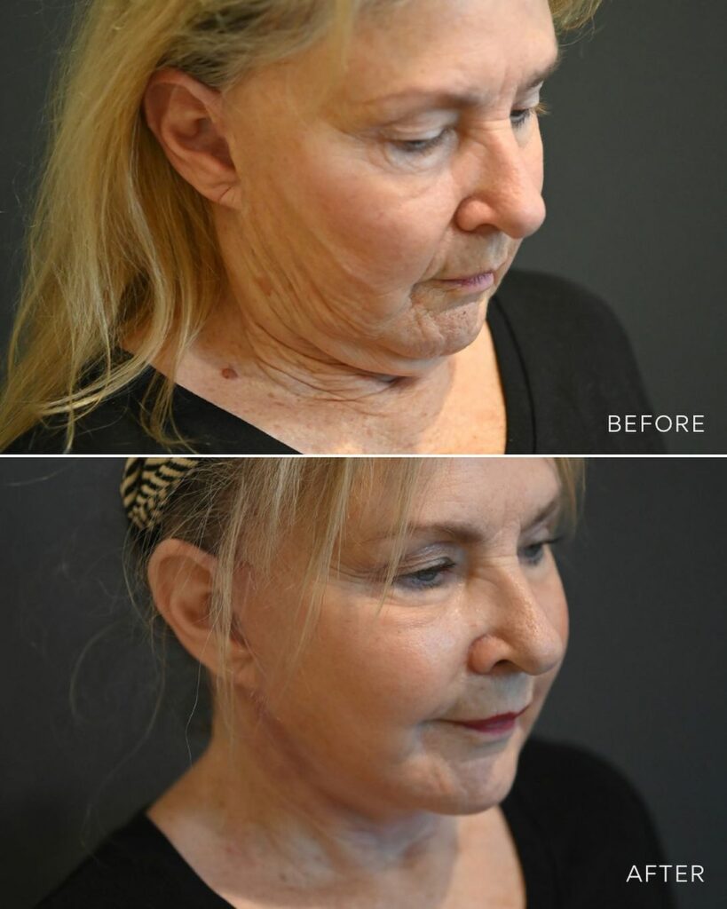 before and after image of a woman who's undergone facelift surgery