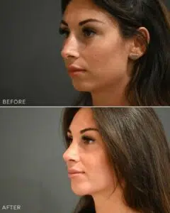 Before and after images of a woman after brow lift surgery