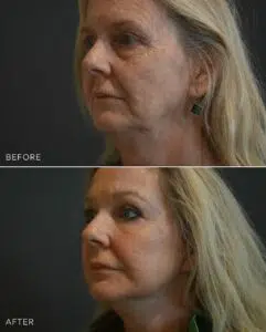 before and after image of a woman who's just undergone cosmetic surgery