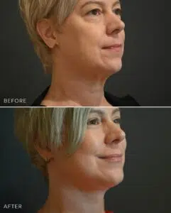 before and after photo of a woman who has just undergone a facelift in sydney