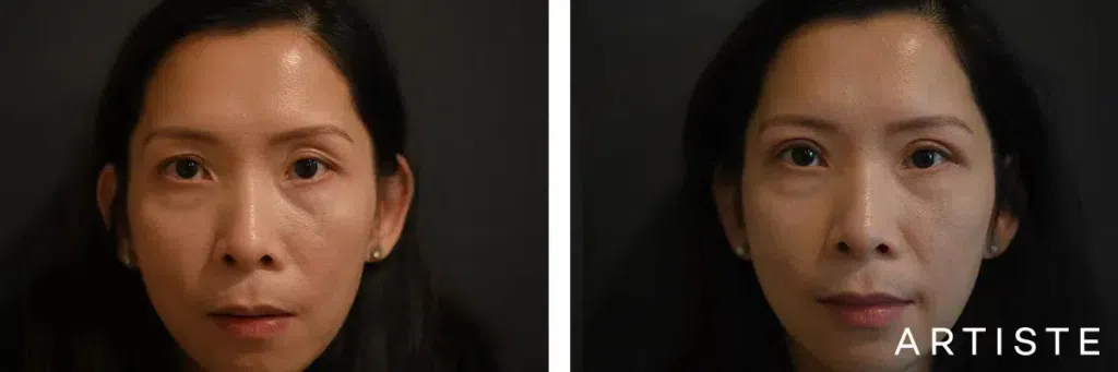 before and after photos of a woman who's just undergone double eyelid surgery. for demonstration purposes
