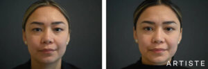 before and after image of an asian woman who has just undergone eyelid surgery