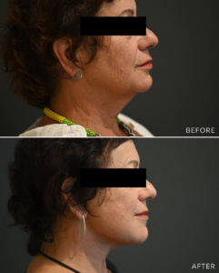 before and after image of a woman who's just undergone a neck lift surgery