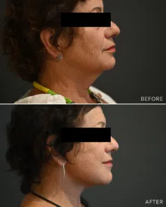 before and after image of a woman who's just undergone a neck lift surgery