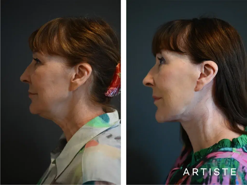 65 Years Old: Deep Plane Face and Neck Lift and Upper Eyelids