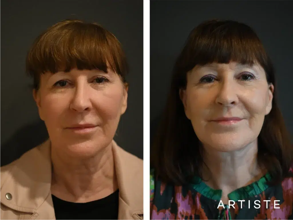 65 Years Old: Deep Plane Face and Neck Lift and Upper Eyelids