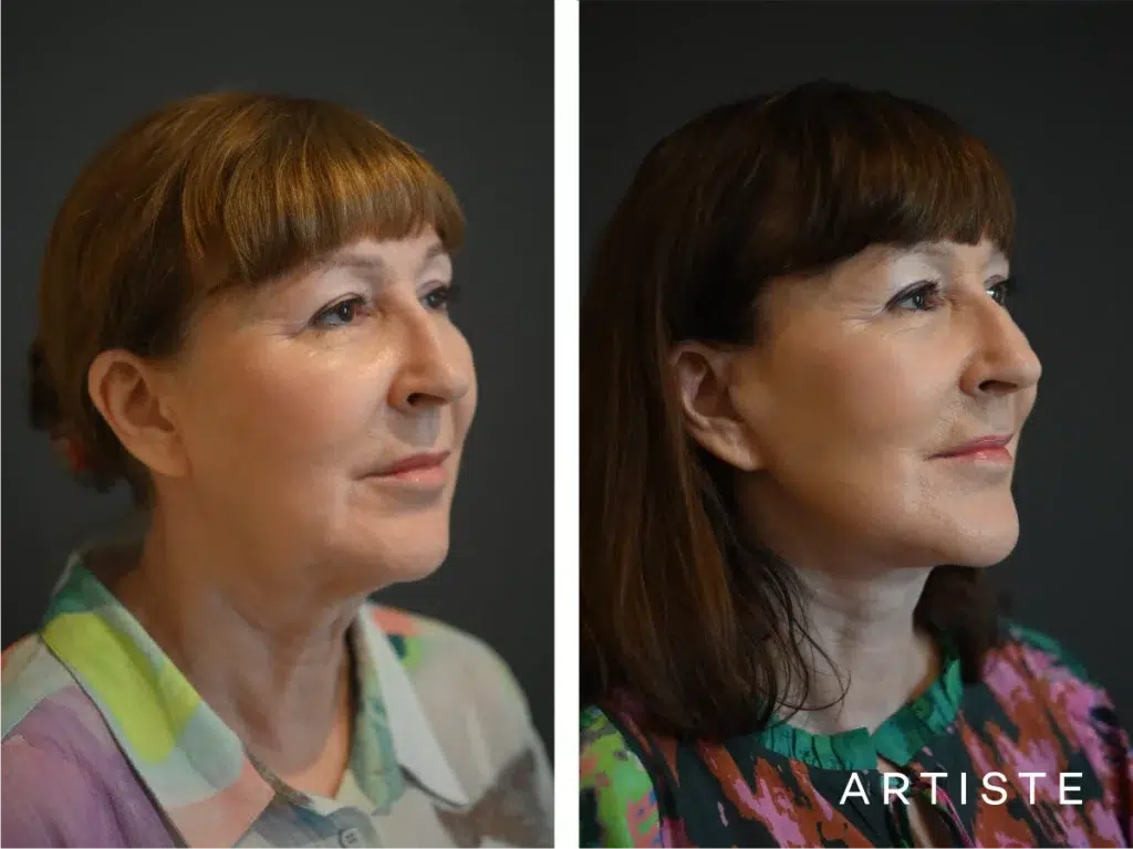 65 Years Old: Deep Plane Face and Neck Lift and Upper Eyelids