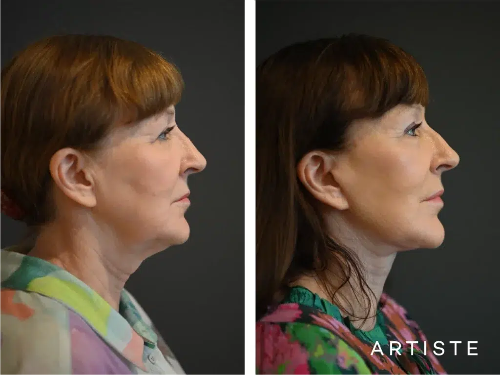 65 Years Old: Deep Plane Face and Neck Lift and Upper Eyelids