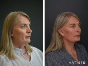 before-and-after angled profile view displaying facial rejuvenation results