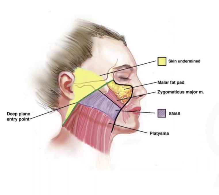 diagram / concept of cosmetic surgery detailing the deep plane entry point