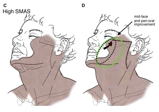 comparison diagram illustrating the effects of high SMAS facelift techniques on mid-face and peri-oral areas