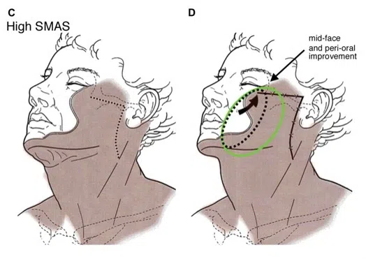 comparison diagram illustrating the effects of high SMAS facelift techniques on mid-face and peri-oral areas