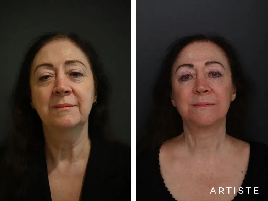 Deep Plane Face and neck lift, upper eyelid blepharoplasty pictured 7 months