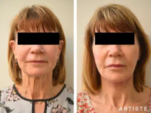 before and after image of a woman after having undergone a cosmetic procedure