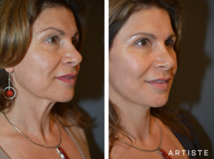 before and after image of a woman after undergoing a cosmetic procedure