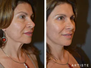 before and after image of a woman after undergoing a cosmetic procedure