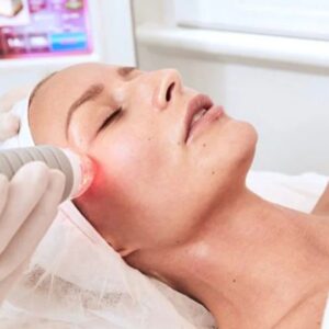 Vivace RF Microneedling Deposit