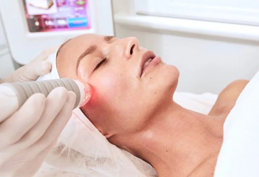 Vivace RF Microneedling Deposit