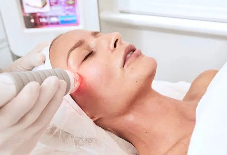 Vivace RF Microneedling